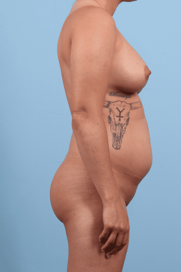 Liposuction Patient Photo - Case 17137 - before view-2