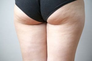 5 Reasons Why QWO Is the Best Cellulite Treatment