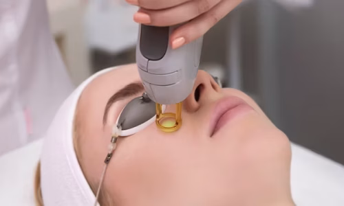 IPL-Eye-SQ PhotoFacial (IPL)