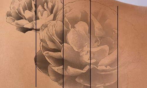 original (6) Laser Tattoo Removal