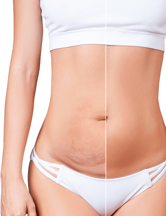 Flatten the Stomach with a Tummy Tuck after Pregnancy