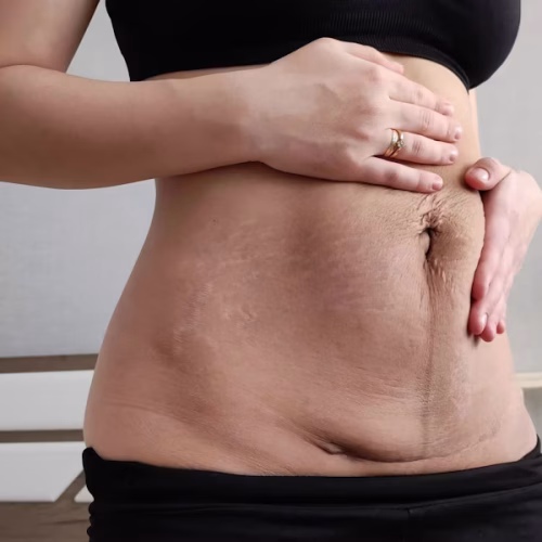 original_excess-skin-on-stomach-after-pregnancy Excess of Skin