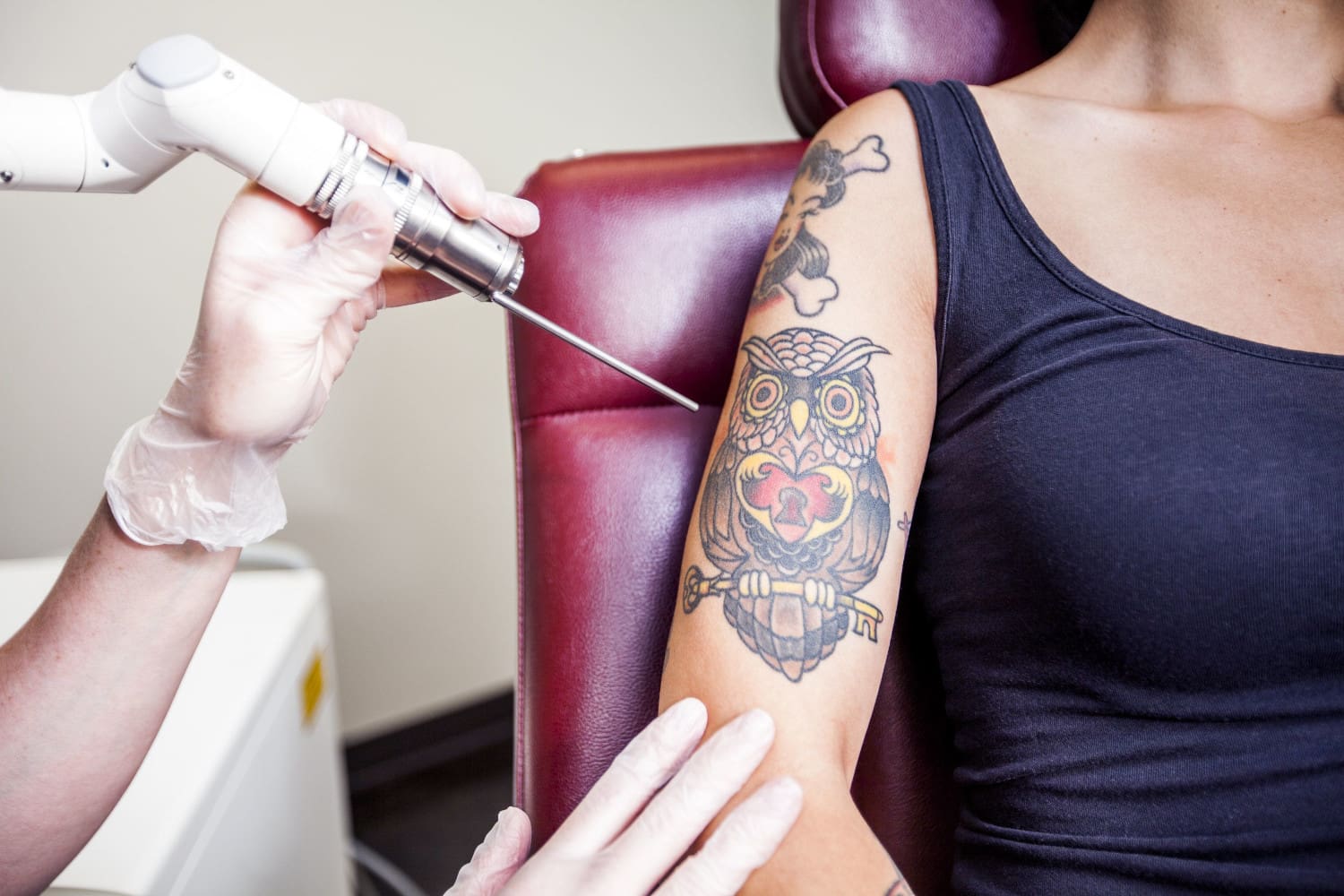 picoway tattoo removal