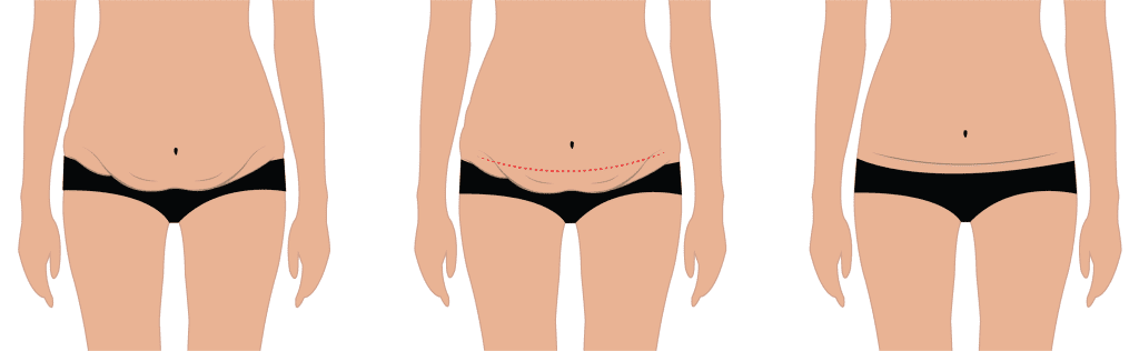 Tummy Tuck Scars: Expectations and Care