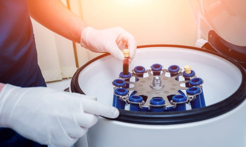 PRP for Hair Loss