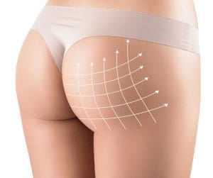 Brazilian Butt Lift Recovery