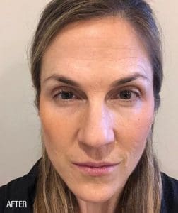 Renuva - Case 22497 - After