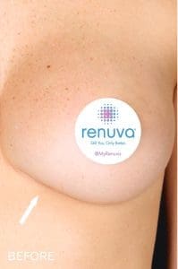 Renuva - Case 22491 - Before