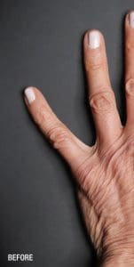 Renuva - Case 22495 - Before