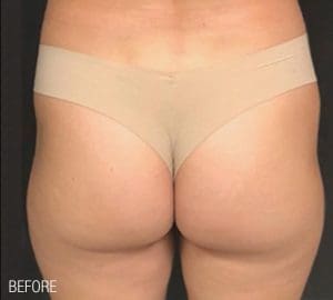 Renuva - Case 22493 - Before