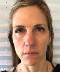 Renuva - Case 22497 - Before