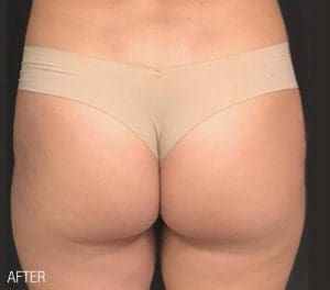 Renuva - Case 22493 - After