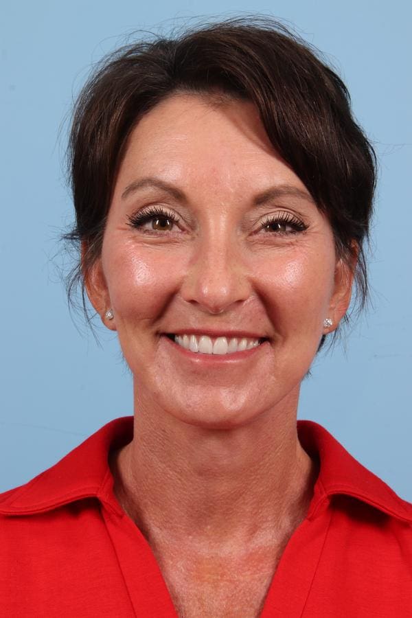 Facelift Patient Photo - Case 23042 - after view-1