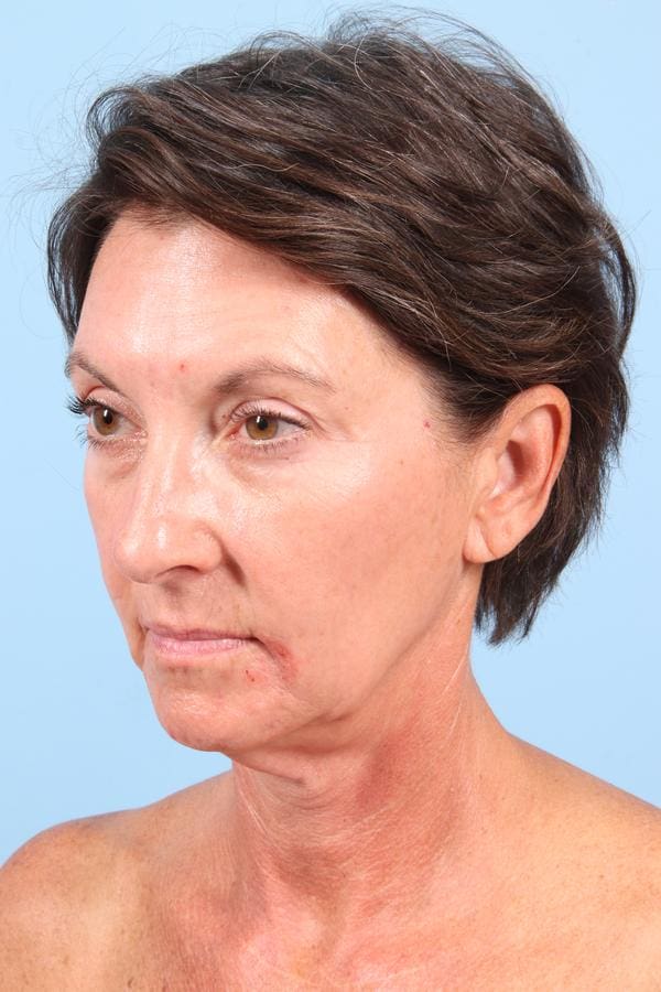Facelift Patient Photo - Case 23042 - before view-2