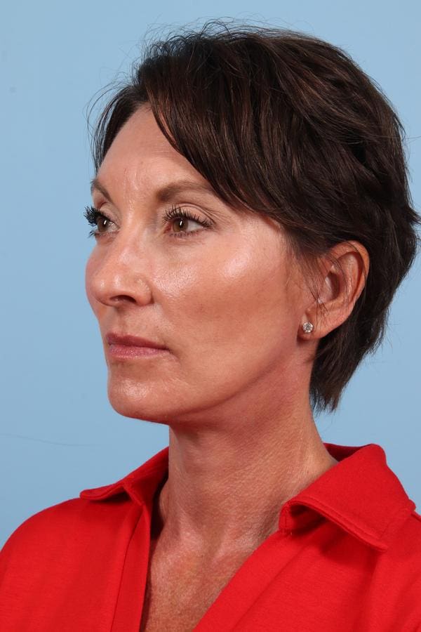 Facelift Patient Photo - Case 23042 - after view-2
