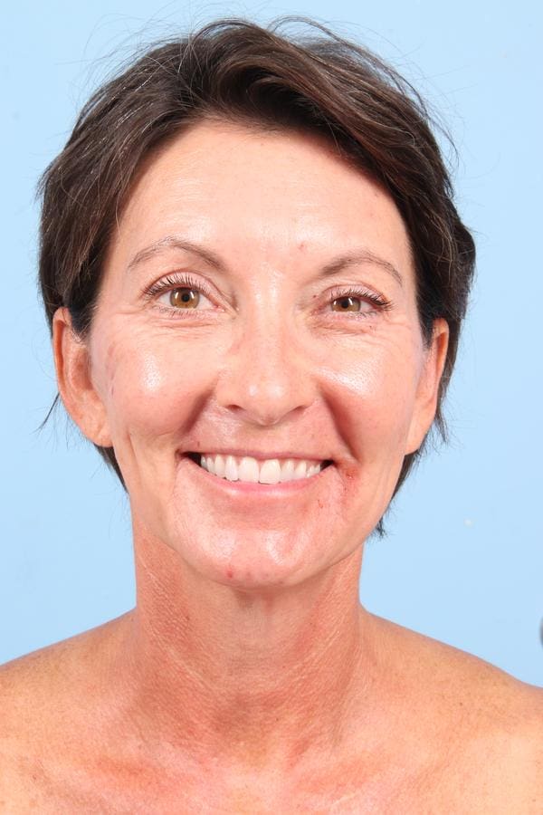 Facelift Patient Photo - Case 23042 - before view-1