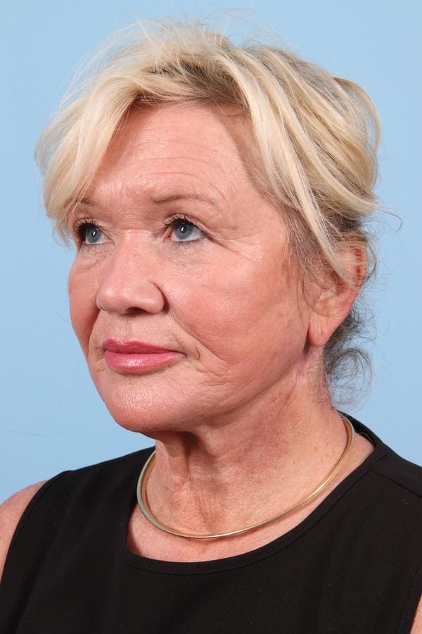 Facelift Patient Photo - Case 23062 - after view-2