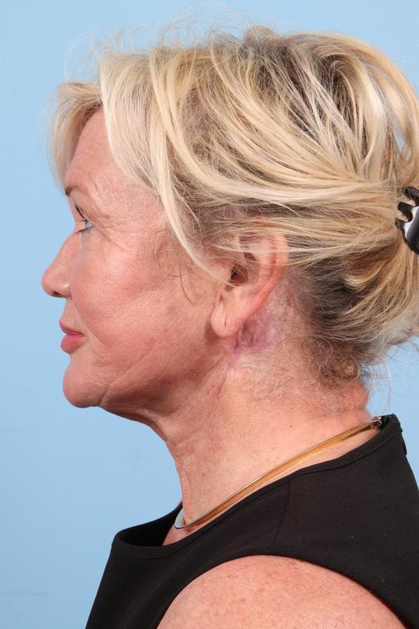Facelift Patient Photo - Case 23062 - after view-3