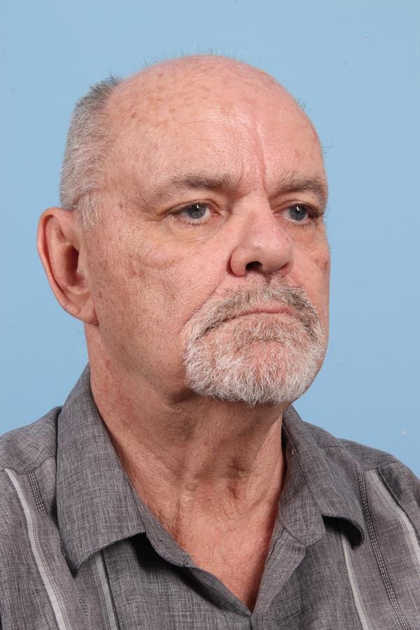 Laser Resurfacing Patient Photo - Case 23076 - before view-2