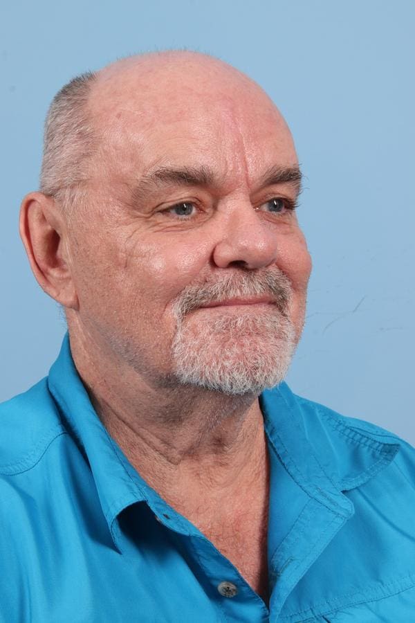 Laser Resurfacing Patient Photo - Case 23076 - after view-2