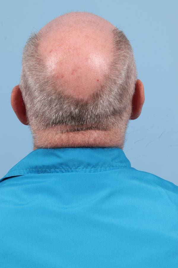 Laser Resurfacing Patient Photo - Case 23076 - after view-5