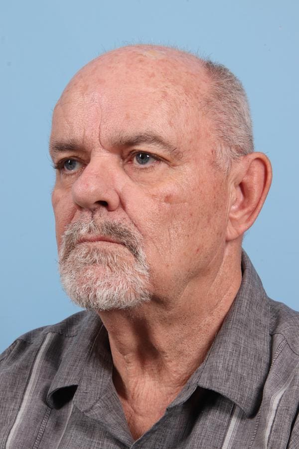 Laser Resurfacing Patient Photo - Case 23076 - before view-1