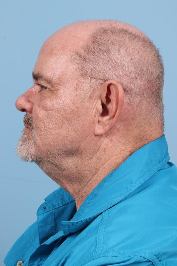 Laser Resurfacing Patient Photo - Case 23076 - after view-4