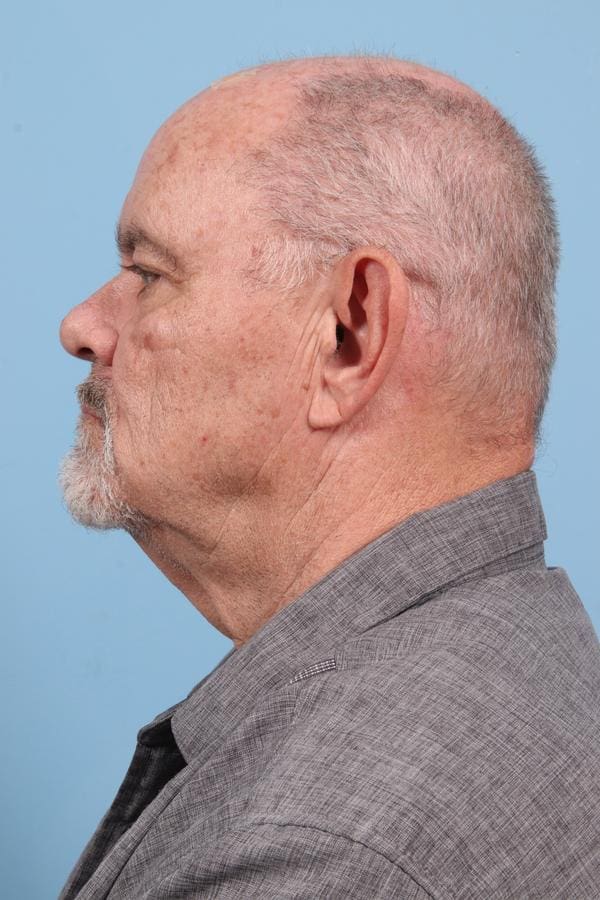 Laser Resurfacing Patient Photo - Case 23076 - before view-4