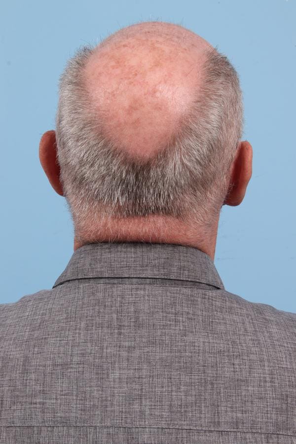 Laser Resurfacing Patient Photo - Case 23076 - before view-5