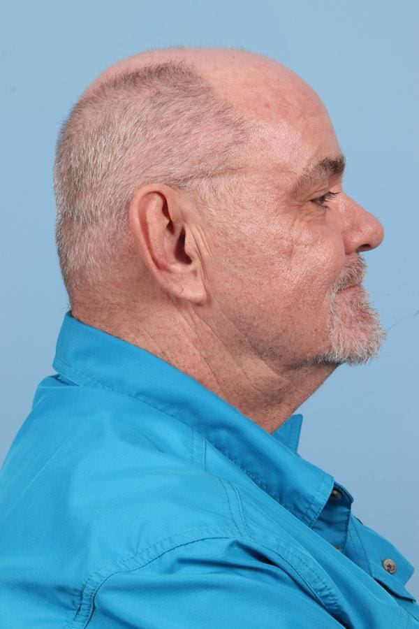 Laser Resurfacing Patient Photo - Case 23076 - after view-3