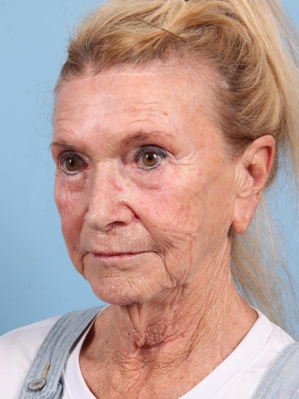 Facelift Patient Photo - Case 23090 - before view-1