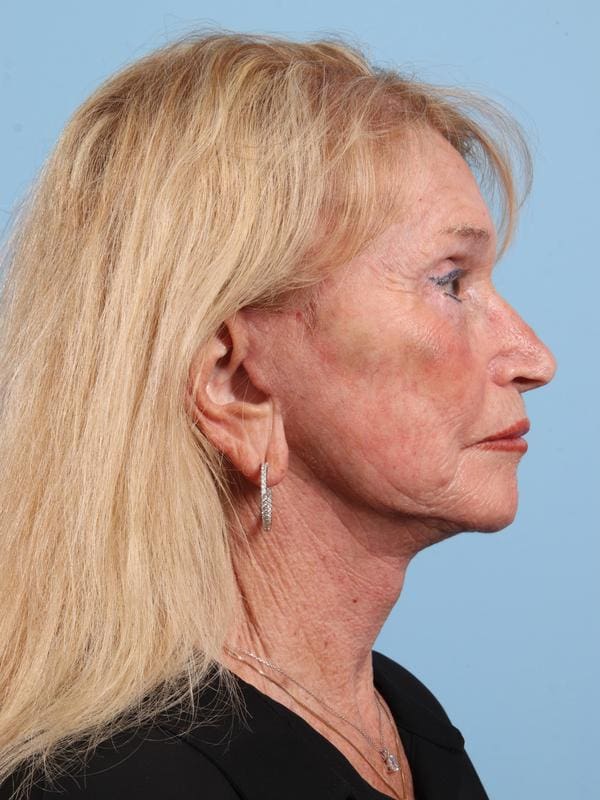 Facelift Patient Photo - Case 23090 - after view-3