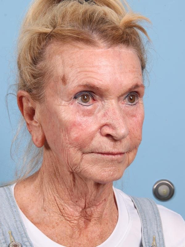 Facelift Patient Photo - Case 23090 - before view-2