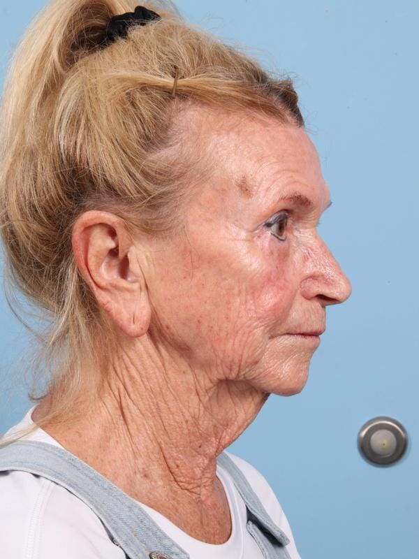 Facelift Patient Photo - Case 23090 - before view-3