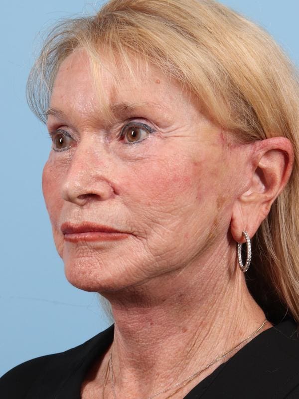 Facelift Patient Photo - Case 23090 - after view-1