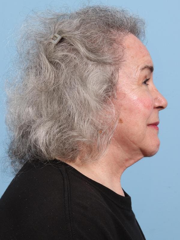 Hair Restoration Patient Photo - Case 23103 - after view-5