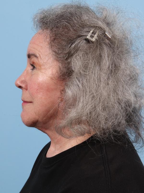 Hair Restoration Patient Photo - Case 23103 - after view-3