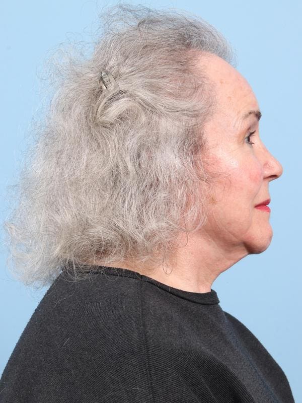 Hair Restoration Patient Photo - Case 23103 - before view-5