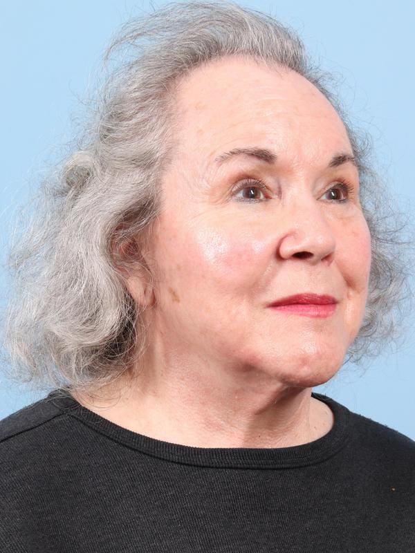 Hair Restoration Patient Photo - Case 23103 - before view-4