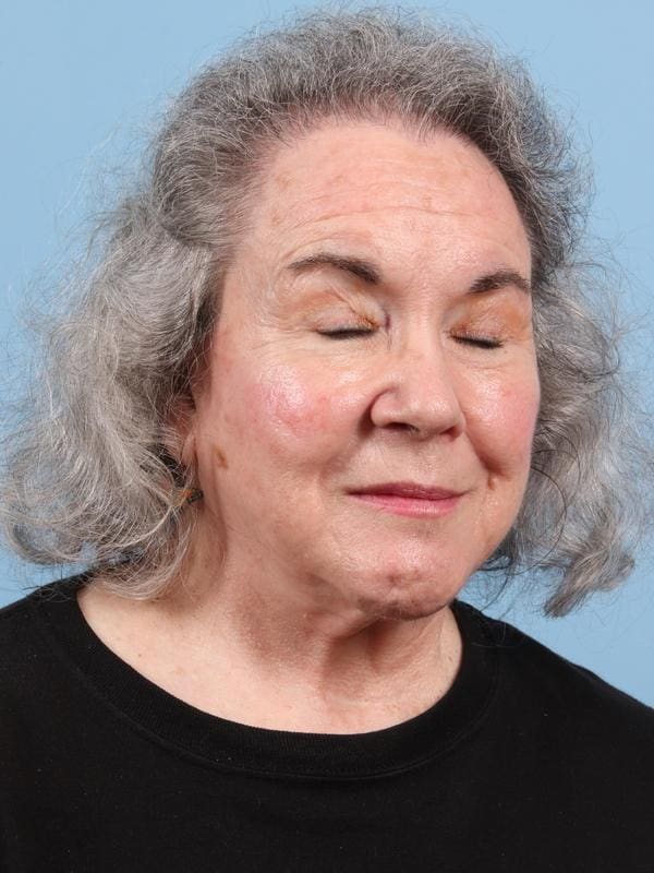 Hair Restoration Patient Photo - Case 23103 - after view-4