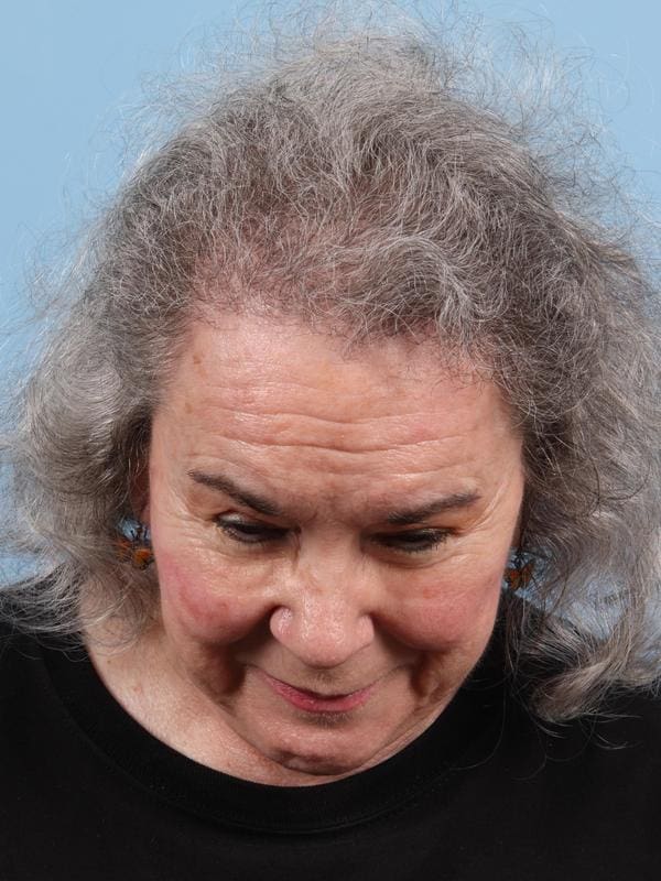 Hair Restoration Patient Photo - Case 23103 - after view-1