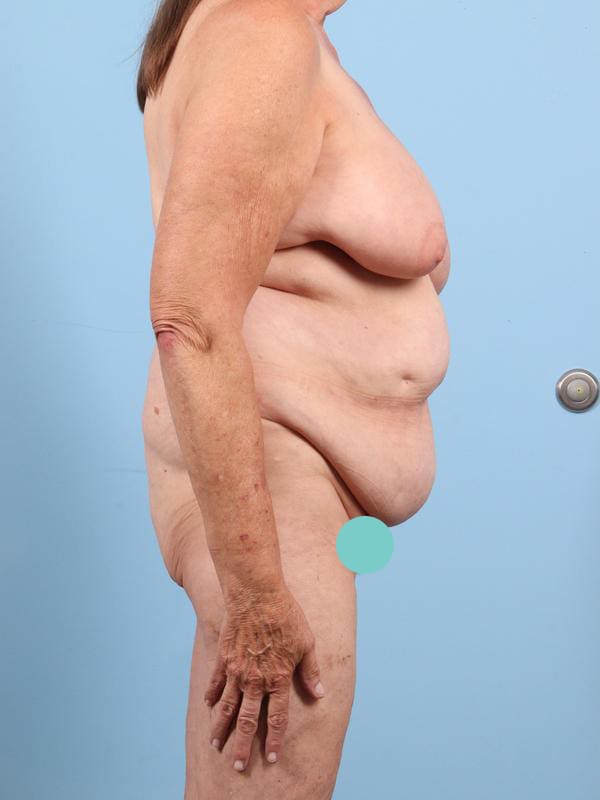 Abdominoplasty Patient Photo - Case 23174 - before view-4