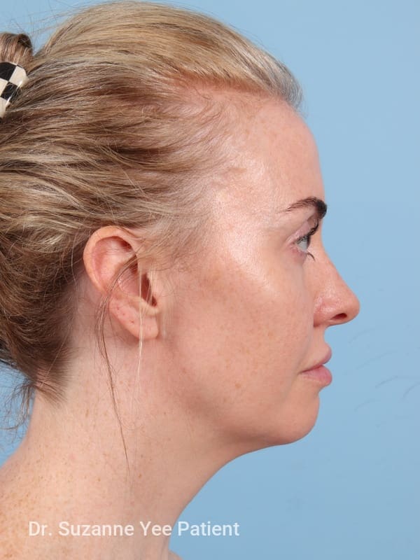 Brow Lift Patient Photo - Case 23345 - before view-4