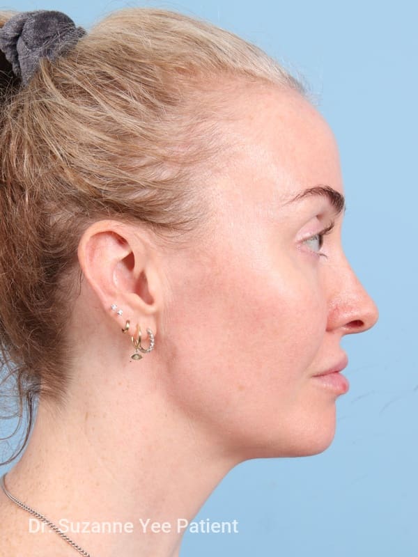 Brow Lift Patient Photo - Case 23345 - after view-4