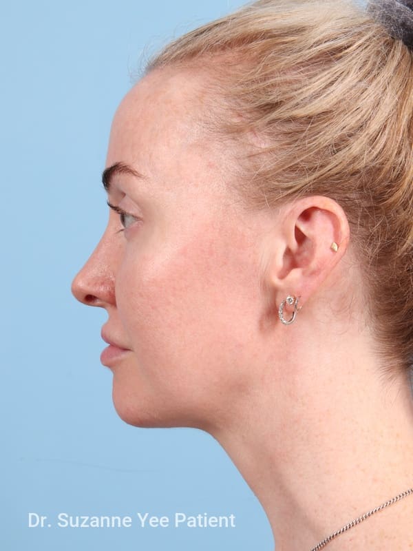 Brow Lift Patient Photo - Case 23345 - after view-1