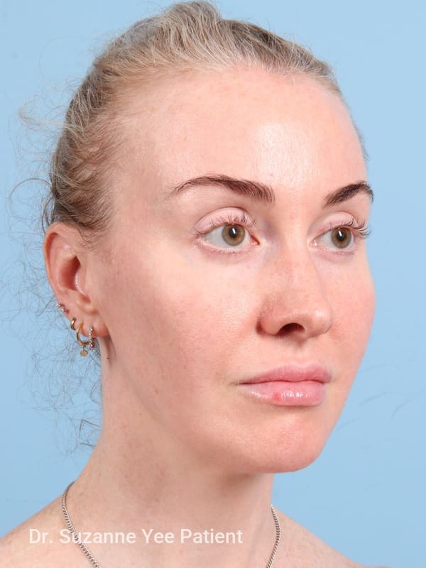 Brow Lift Patient Photo - Case 23345 - after view-3