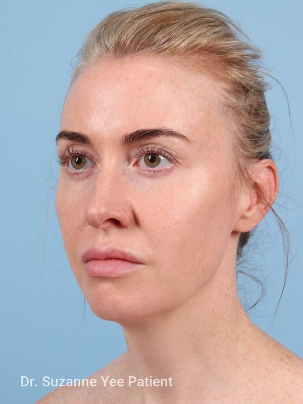 Brow Lift Patient Photo - Case 23345 - before view-2