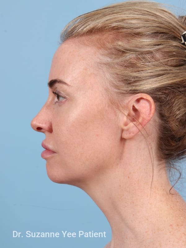 Brow Lift Patient Photo - Case 23345 - before view-1