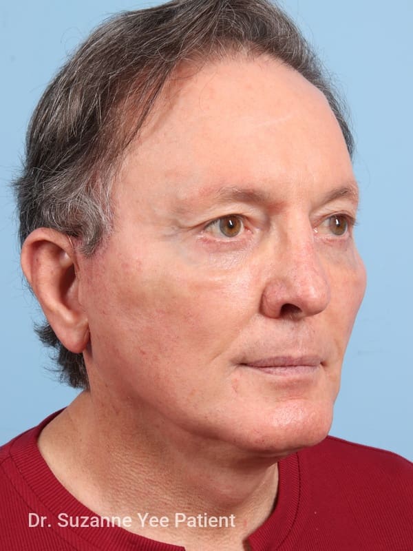 Facelift Patient Photo - Case 23503 - after view-3