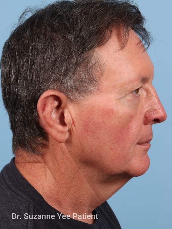 Facelift Patient Photo - Case 23503 - before view-4